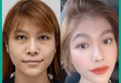 Before and after rhinoplasty results at ID Clinic Bangkok, nose reshaping with natural look