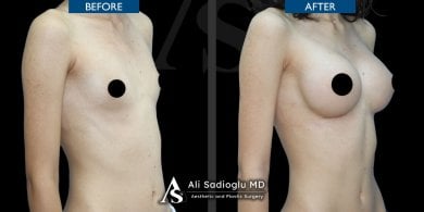 Before and after breast implants with lift results at Dr. Safa Manav Clinic, enhanced contour