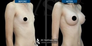 Before and after breast implants with lift results at Dr. Safa Manav Clinic, enhanced contour