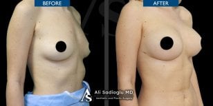 Before and after breast implants with lift results at Dr. Safa Manav Clinic, enhanced contour