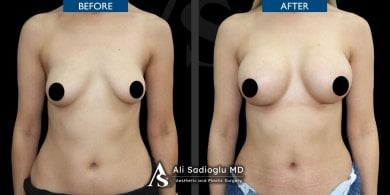 Before and after breast implants with lift results at Dr. Safa Manav Clinic, enhanced contour