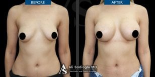 Before and after breast implants with lift results at Dr. Safa Manav Clinic, enhanced contour
