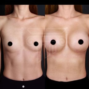 Before and after breast implants with lift results at Dr. Safa Manav Clinic, enhanced contour