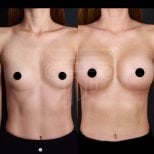 Before and after breast implants with lift results at Dr. Safa Manav Clinic, enhanced contour
