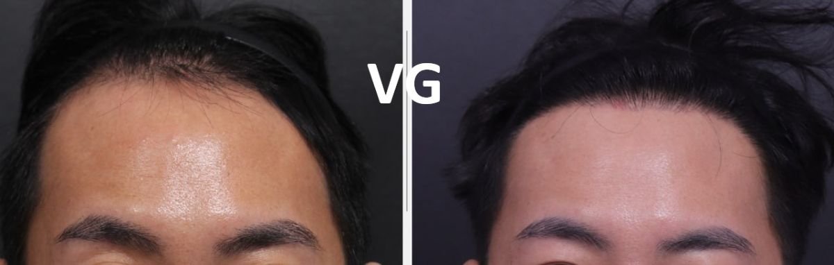 Resultados antes y después del tratamiento PRP para caída del cabello en VG Plastic Surgery