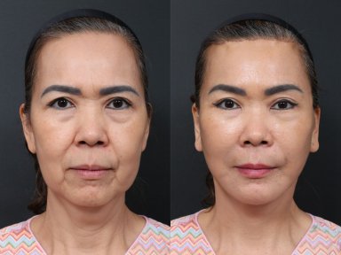 До и после липофилинга в RNWOOD Plastic Surgery, видимый результат омоложения лица