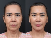 До и после липофилинга в RNWOOD Plastic Surgery, видимый результат омоложения лица