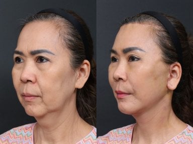 Результаты липофилинга лица до и после в RNWOOD Plastic Surgery – восстановление объема