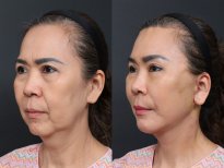 Результаты липофилинга лица до и после в RNWOOD Plastic Surgery – восстановление объема