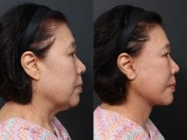 Результаты до и после deep plane SMAS-лифтинга в RNWOOD Plastic Surgery, видимый лифтинг