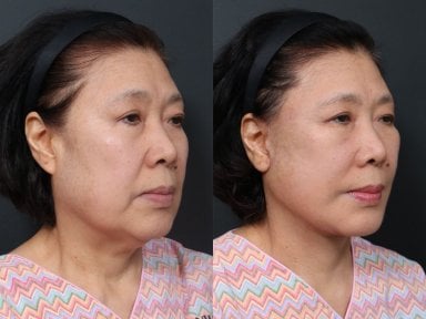 Результаты до и после deep plane SMAS-лифтинга в RNWOOD Plastic Surgery, омоложение лица