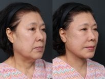Результаты до и после deep plane SMAS-лифтинга в RNWOOD Plastic Surgery, омоложение лица