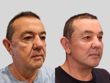 Результаты до и после deep plane SMAS лифтинга в RNWOOD Plastic Surgery, омоложение лица