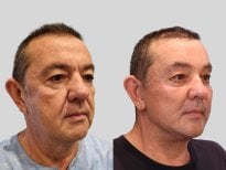 Результаты до и после deep plane SMAS лифтинга в RNWOOD Plastic Surgery, омоложение лица