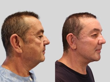 Результат до и после deep plane подтяжки лица в RNWOOD Plastic Surgery, омоложение лица
