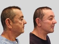 Результат до и после deep plane подтяжки лица в RNWOOD Plastic Surgery, омоложение лица