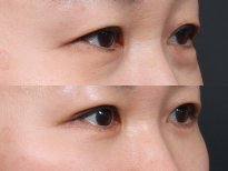 Результаты блефаропластики до и после в RNWOOD Plastic Surgery, коррекция век