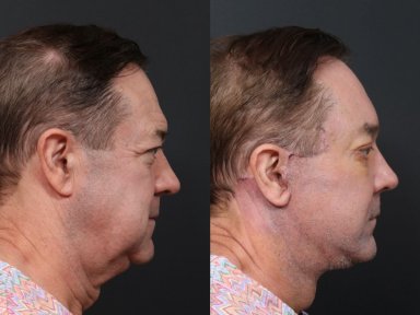 Результаты липофилинга до и после в RNWOOD Plastic Surgery, улучшенный контур челюсти