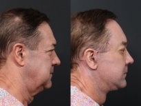 Результаты липофилинга до и после в RNWOOD Plastic Surgery, улучшенный контур челюсти