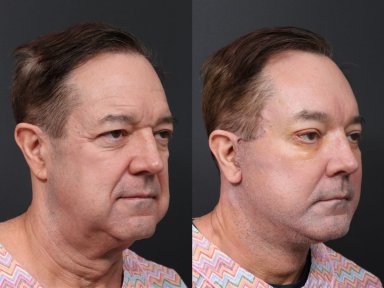 Результаты липофилинга лица до и после в RNWOOD Plastic Surgery, восстановление объема