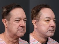 Результаты липофилинга лица до и после в RNWOOD Plastic Surgery, восстановление объема