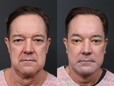 Результаты липофилинга лица до и после в RNWOOD Plastic Surgery, улучшение контура