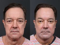 Результаты липофилинга лица до и после в RNWOOD Plastic Surgery, улучшение контура
