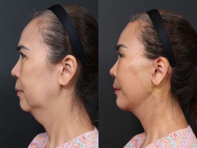 Результаты липофилинга до и после в RNWOOD Plastic Surgery, улучшение контура лица