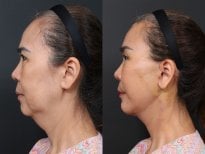 Результаты липофилинга до и после в RNWOOD Plastic Surgery, улучшение контура лица
