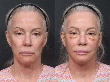 Результаты до и после подтяжки шеи в RNWOOD Plastic Surgery, видимое омоложение лица