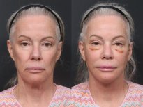 Результаты до и после подтяжки шеи в RNWOOD Plastic Surgery, видимое омоложение лица
