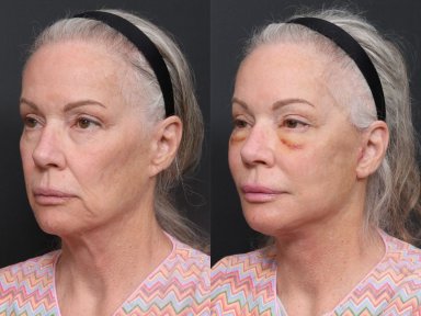 Результаты до и после подтяжки шеи в RNWOOD Plastic Surgery, улучшение контура шеи и челюсти