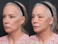 Результаты до и после подтяжки шеи в RNWOOD Plastic Surgery, улучшение контура шеи и челюсти