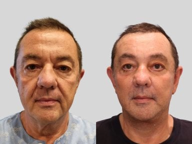 Результаты до и после подтяжки шеи в RNWOOD Plastic Surgery, улучшение контура шеи