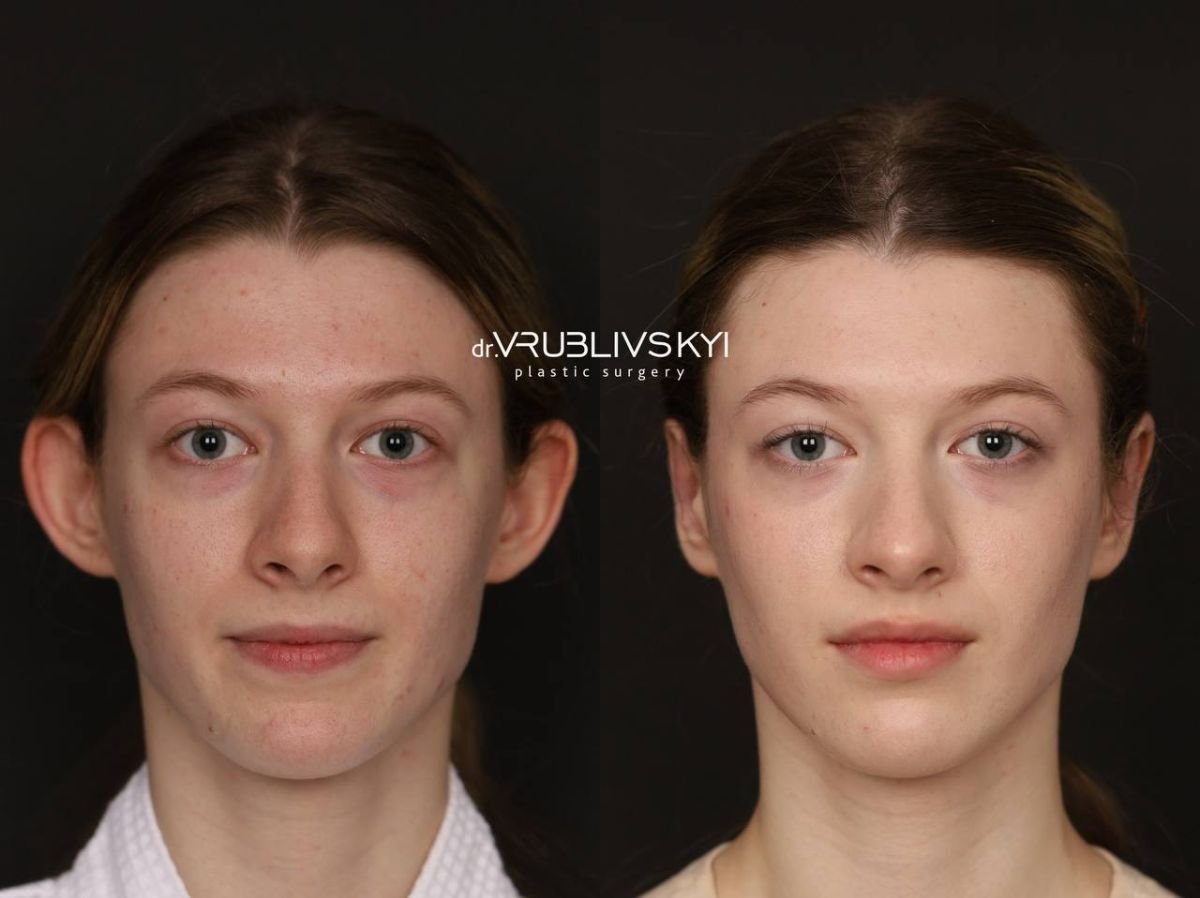 Resultados de otoplastia antes y después en Dr. VRUBLIVSKYI Plastic Surgery, corrección de orejas