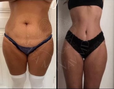 Before and after 360 liposuction results at Dr. Safa Manav Clinic, body contouring improvement