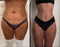 Before and after 360 liposuction results at Dr. Safa Manav Clinic, body contouring improvement