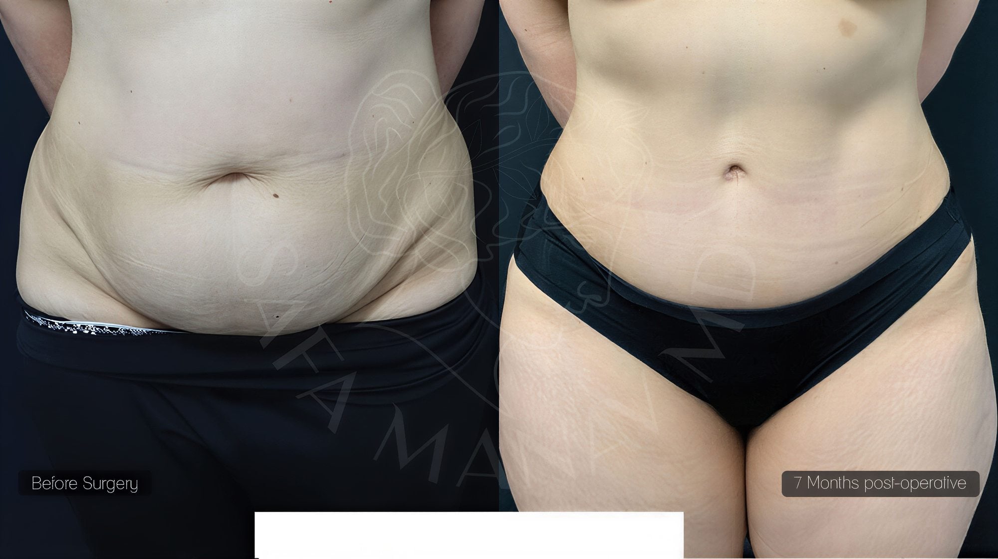 Resultados de liposucción 360 antes y después en Dr. Safa Manav Clinic, contorno visible