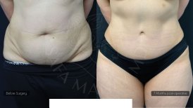 Before and after 360 liposuction results at Dr. Safa Manav Clinic, visible body contouring