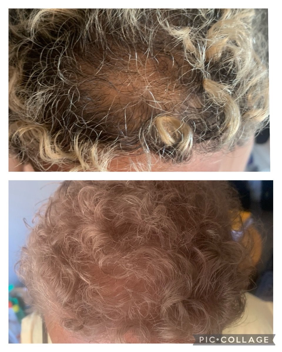 قبل وبعد علاج تجديد الخلايا الجذعية في Juventa Regenerative Medicine، نتيجة نمو الشعر