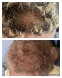 До та після омолодження стовбуровими клітинами в Juventa Regenerative Medicine, результат росту волосся