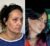 Facelift before and after results at Dr. Safa Manav Clinic, visible facial rejuvenation