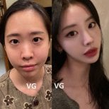 Результаты до и после ринопластики кончика носа в VG Plastic Surgery, улучшение формы
