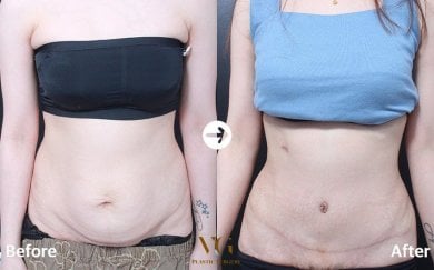 Vorher-nachher-Ergebnis Mommy Makeover bei VG Plastic Surgery, sichtbare Bauchkontur-Verbesserung