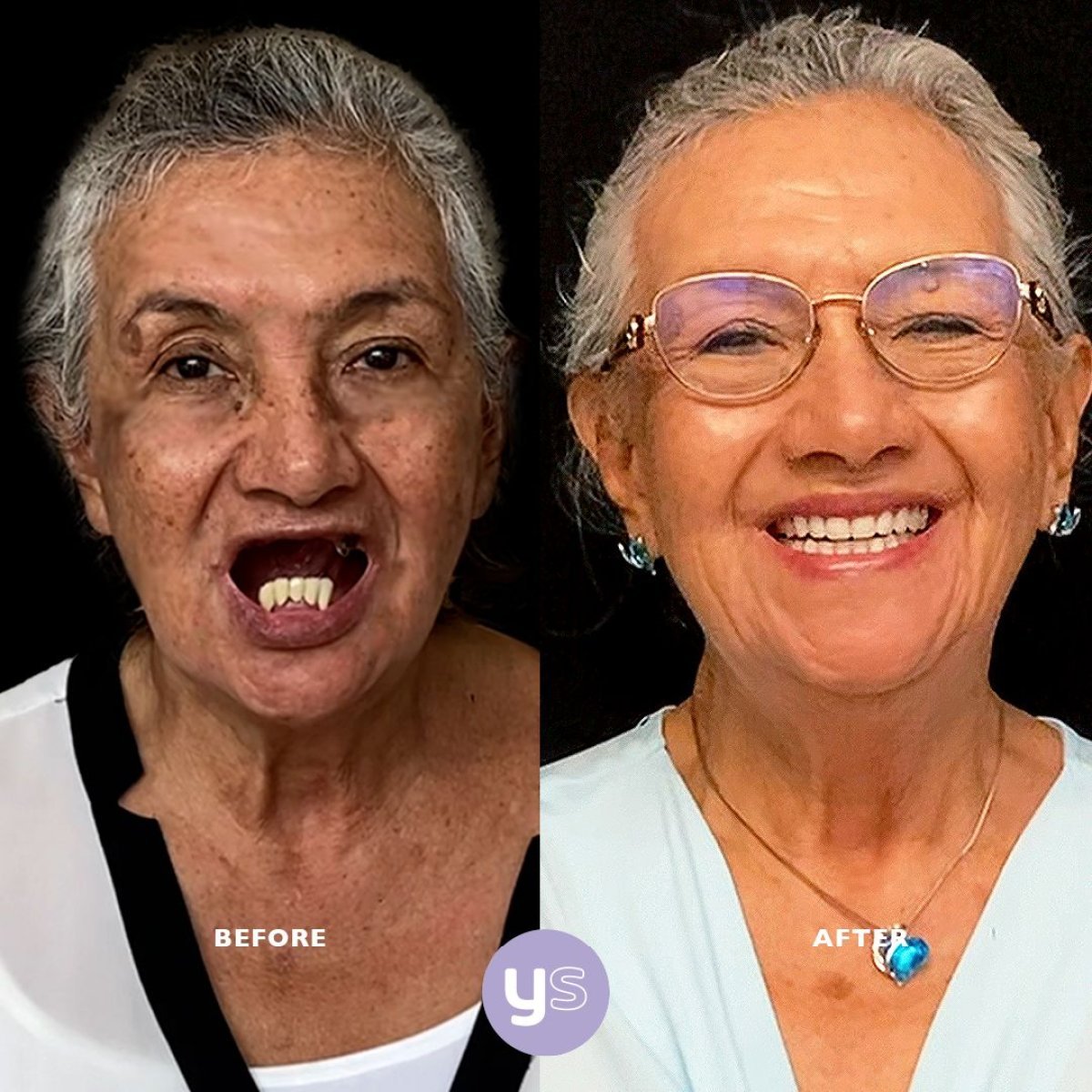 Resultados antes y después de coronas dentales en YeahSmile – sonrisa restaurada
