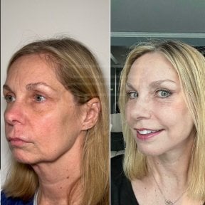 Facelift before and after results at Dr. Safa Manav Clinic, visible facial rejuvenation
