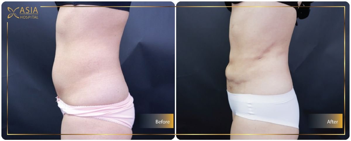 Resultados antes y después de liposucción Vaser abdominal en Asia Cosmetic Hospital, mejor contorno