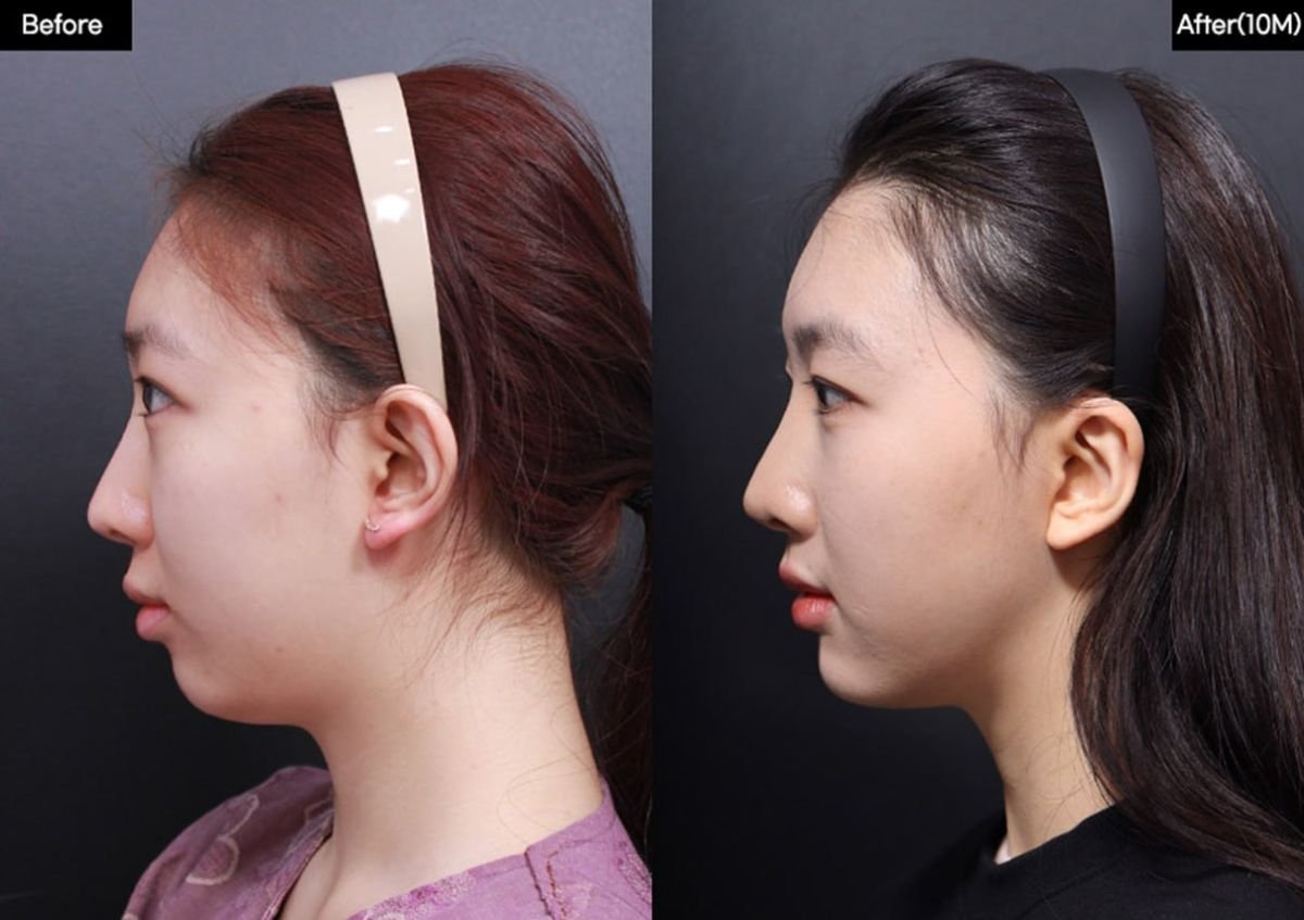 قبل وبعد زراعة الذقن في VG Plastic Surgery، تحسين شكل الذقن والملف الجانبي للوجه