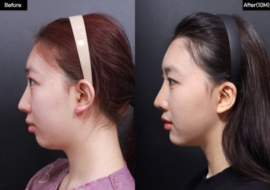 До и после имплантации подбородка в VG Plastic Surgery, улучшенный контур подбородка
