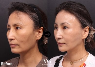 Результаты до и после имплантации подбородка в VG Plastic Surgery – улучшенный контур